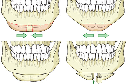 下巴截骨手术过程图解