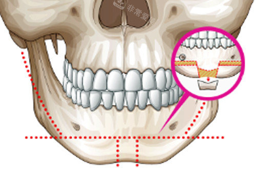 下巴截骨手术位置图解