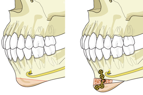 “月亮脸”下巴截骨手术前后图解