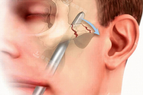 颧骨颧弓手术过程图解