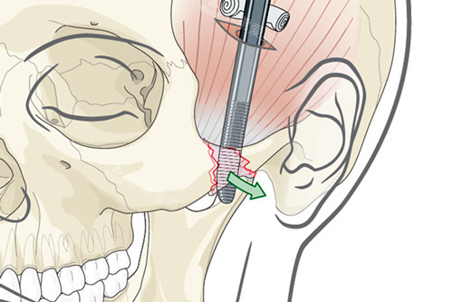 颧骨颧弓磨骨手术过程图解