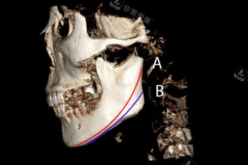 下颌角整形两种不同的手术方案图解