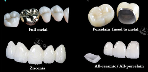 全瓷牙冠和烤瓷牙冠的外观