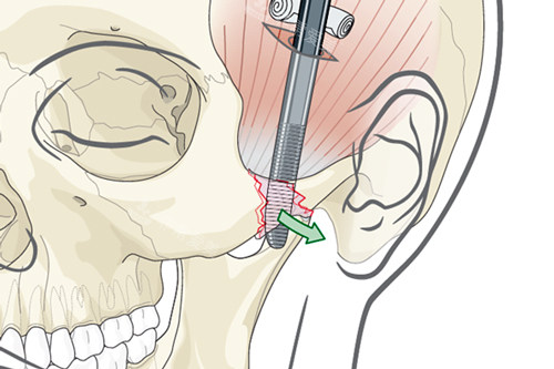颧骨内推手术过程图解