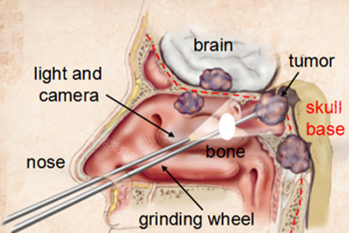 磨骨手术过程图解