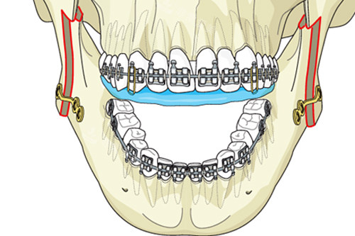下颌角弧线截骨术固定后图解