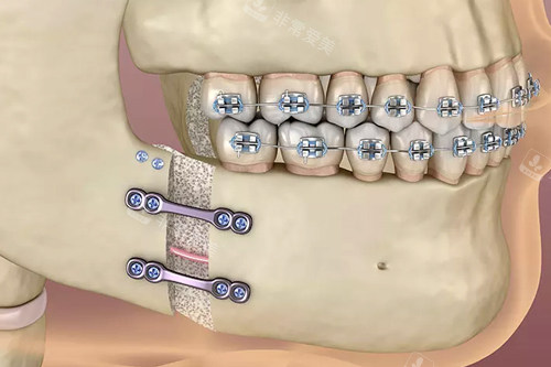 正颌手术过程图解