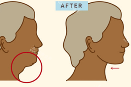 面部埋线提升去双下巴前后对比