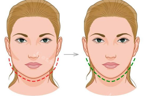 脸部埋线塑造小V脸前后对比图