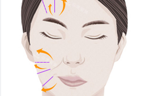 面部埋线提升手术前后对比图