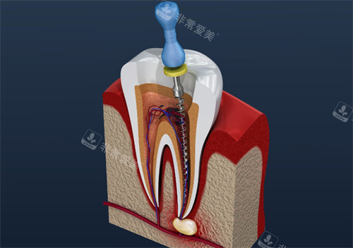 牙齿进行根管治疗的剖析图