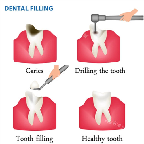 补牙的方式