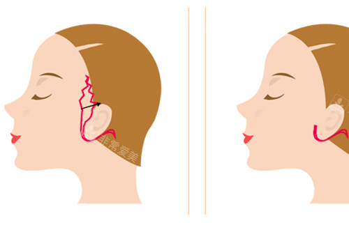 拉皮手术切口位置图解