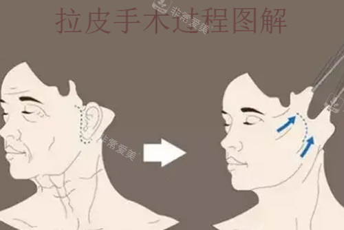 拉皮手术过程图解