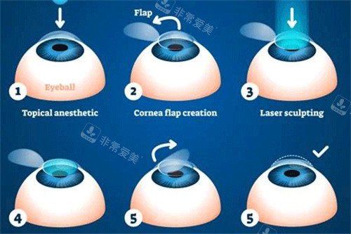 全飞秒近视手术过程图解
