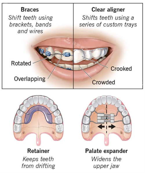 不同类型的牙齿矫正