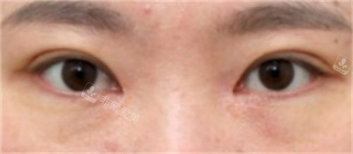 韓國sone眼修復手術(shù)后 韓國sone眼修復手術(shù)后