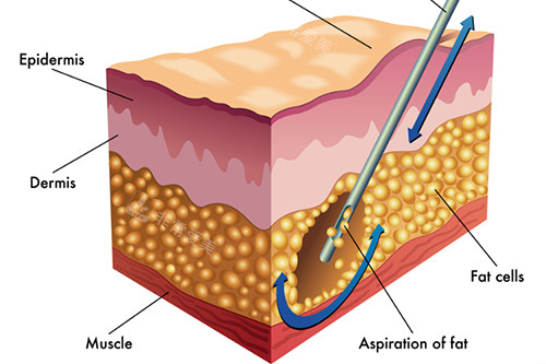 吸脂仪器在皮肤底层的工作图示