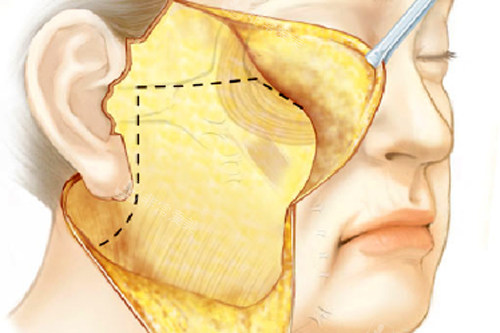 大拉皮手术切口位置及剥离过程图解