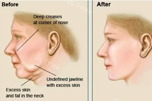 拉皮手术前后对比图