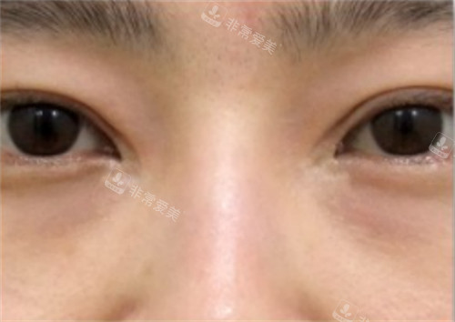 韓國SONE整形眼修復手術(shù)前 韓國SONE整形眼修復手術(shù)前