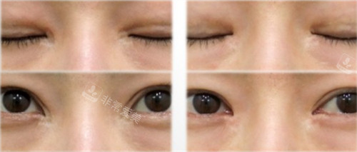 韩国SONE整形眼修复手术对比图