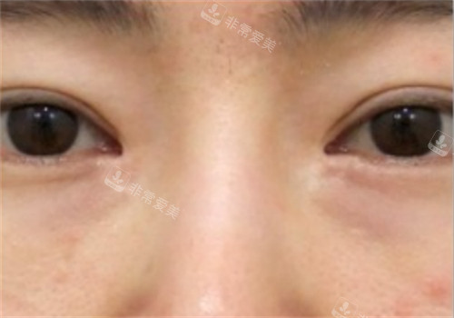 韓國SONE整形眼修復手術(shù)后 韓國SONE整形眼修復手術(shù)后