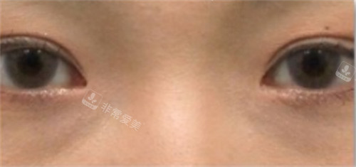 韓國(guó)sone整形雙眼皮手術(shù)修復(fù)后 韓國(guó)sone整形雙眼皮手術(shù)修復(fù)后