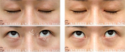 韩国sone整形双眼皮修复手术对比图