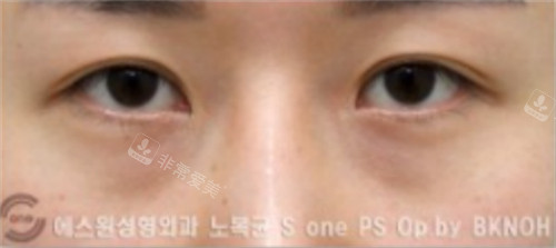 韩国sone整形双眼皮修复手术前