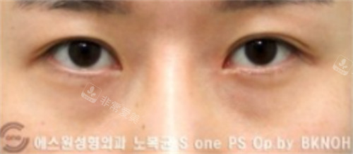 韩国sone整形双眼皮修复手术后