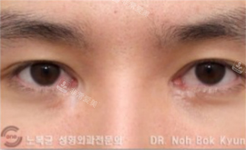 在韩国sone整形做双眼皮修复手术前