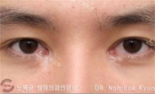 在韓國sone整形做雙眼皮修復手術(shù)前