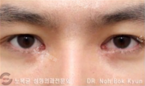 在韩国sone整形做双眼皮修复手术后