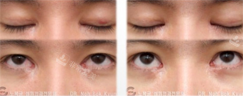在韩国sone整形做双眼皮修复手术对比图