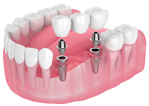 种植牙在口腔中的表现