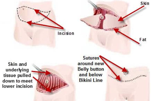 腹部拉皮手术过程图解
