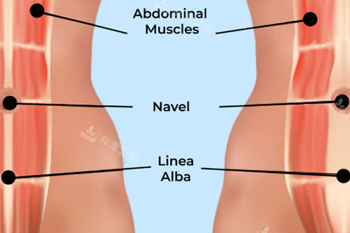 腹壁整形术中腹直肌位置图片