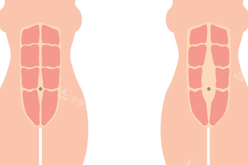 腹壁整形术缝合腹直肌前后图解