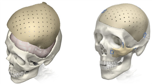 修补颅骨的PEEK材料