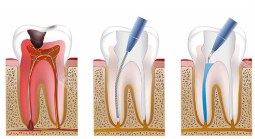 牙神经出现问题需要进行根管治疗