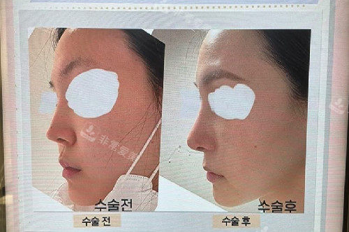 韩国NANO整形医院肋软骨鼻修复对比