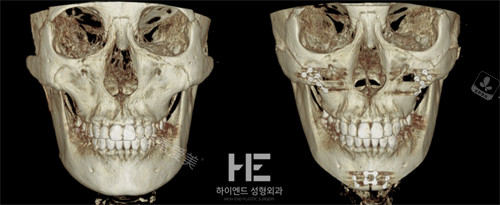 韩国合意颜得整形外科面部轮廓整形前后对比图