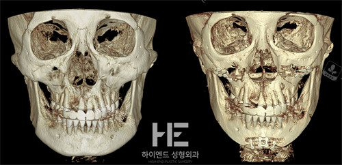 韓國合意顏得整形面部輪廓整形前后對(duì)比圖 韓國合意顏得整形面部輪廓整形前后對(duì)比圖