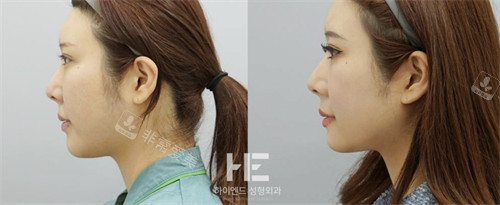 韩国合意颜得整形下颌角手术前后对比图
