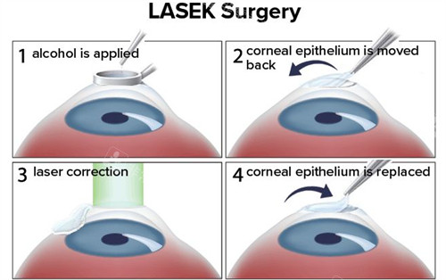 近视手术激光手术过程
