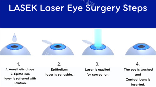 近视手术过程图