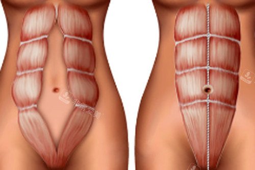 腹直肌修复手术前后对比图