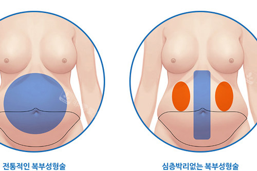 迷你腹壁成形手术过程图解