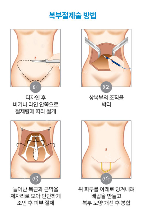 迷你腹壁成形手术过程图解